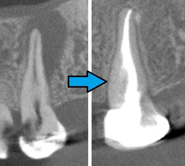 X-ray of an infected tooth before treatment and healed after root canal treatment